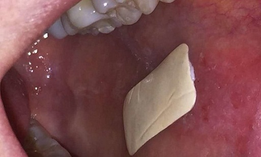 ابداع نوعی پچ برای درمان زخم‌های داخل دهان