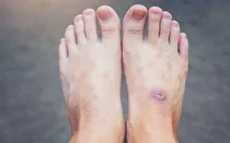 زخم‌های دیابتی از عوارض مهم و نگران‌کننده دیابت هستند