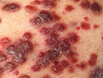 تأثیر بالای عوامل محیطی در بروز انواع سرطان‌ها